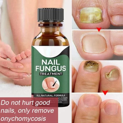 Fast Nail Fungal Treatments Nail Repair Essences Serum Care Treatments Foot Nail