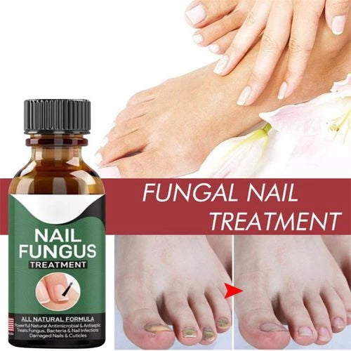 Fast Nail Fungal Treatments Nail Repair Essences Serum Care Treatments Foot Nail