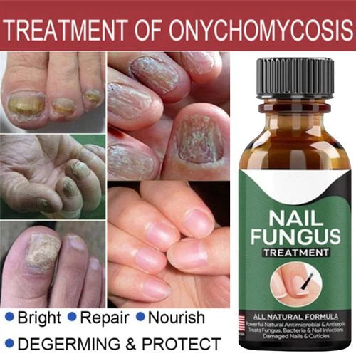 Fast Nail Fungal Treatments Nail Repair Essences Serum Care Treatments Foot Nail