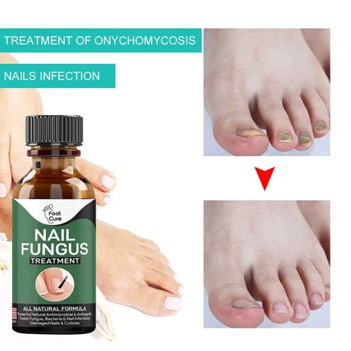 Fast Nail Fungal Treatments Nail Repair Essences Serum Care Treatments Foot Nail