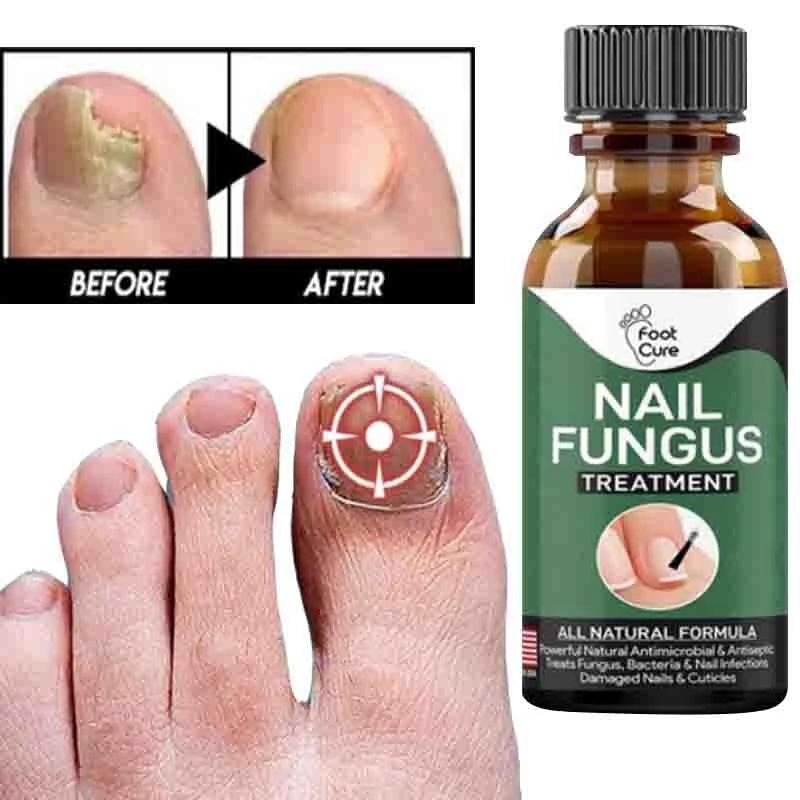 Fast Nail Fungal Treatments Nail Repair Essences Serum Care Treatments Foot Nail